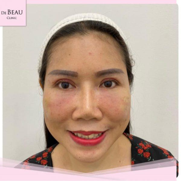 Review ฟิลเลอร์ใต้ตา คุณหน่อย  BY DE BEAU CLINIC