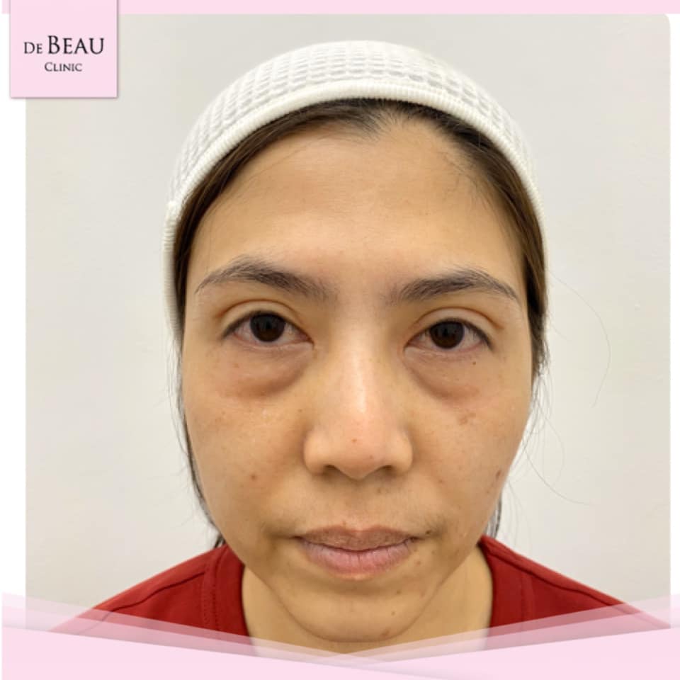 Review ฟิลเลอร์ใต้ตา คุณโจ้  BY DE BEAU CLINIC