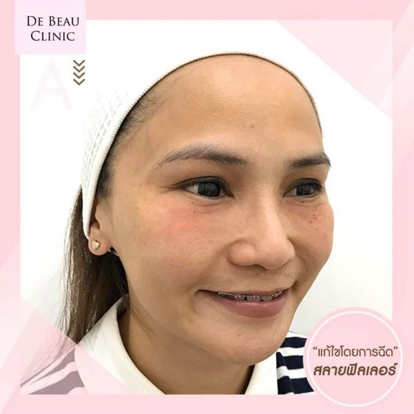 Review ฟิลเลอร์ใต้ตา คุณเอ  BY DE BEAU CLINIC