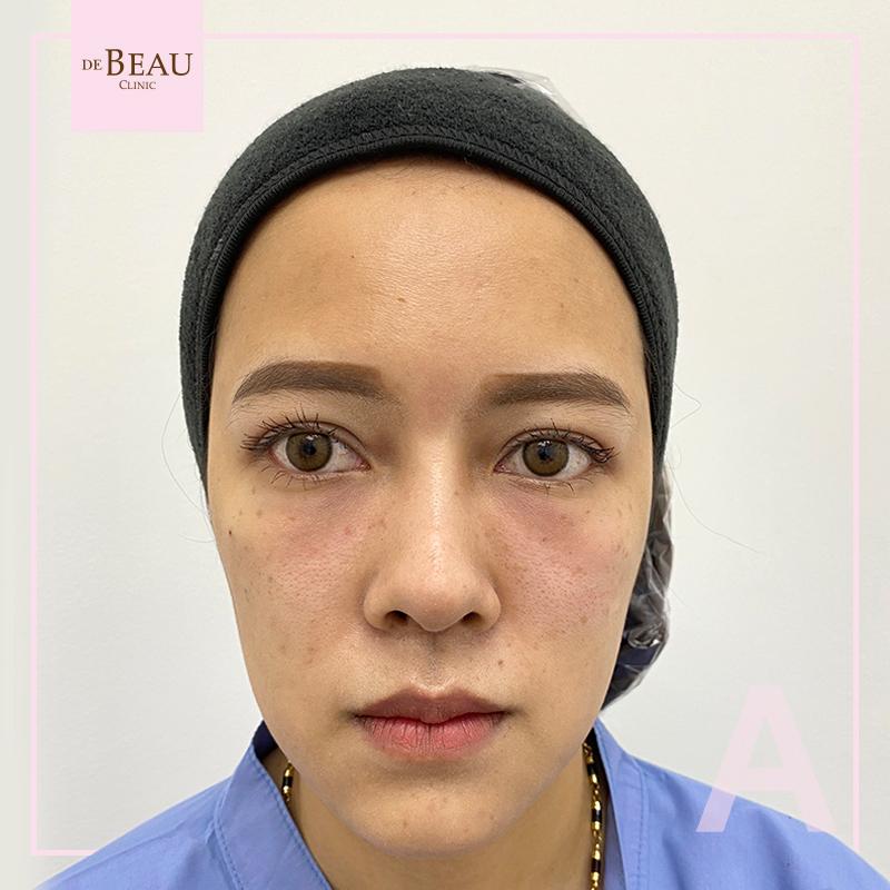 Review ฟิลเลอร์ใต้ตา ขมับตอบ คุณปอ BY DE BEAU CLINIC
