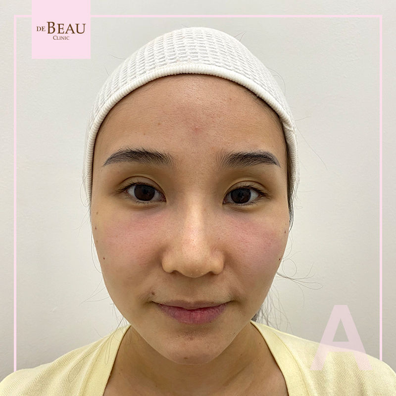 Review ฟิลเลอร์ใต้ตา คุณน้ำหอม BY DE BEAU CLINIC