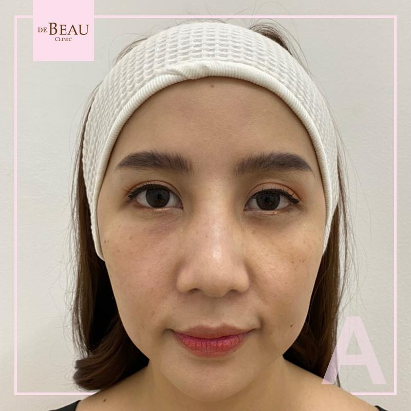 Review ฟิลเลอร์ใต้ตา คุณซีอิ๊ว BY DE BEAU CLINIC