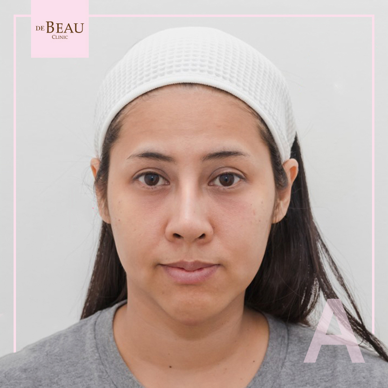Review ฟิลเลอร์ใต้ตา คุณยู BY DE BEAU CLINIC