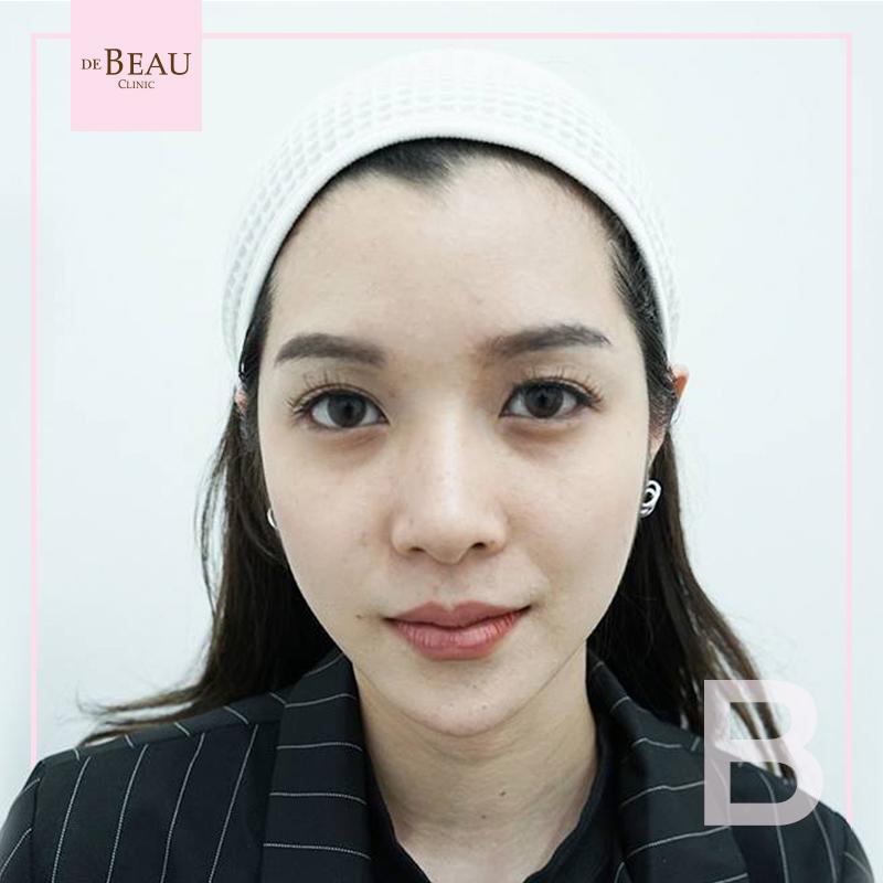 Review ฟิลเลอร์ใต้ตา คุณลิเบีย BY DE BEAU CLINIC
