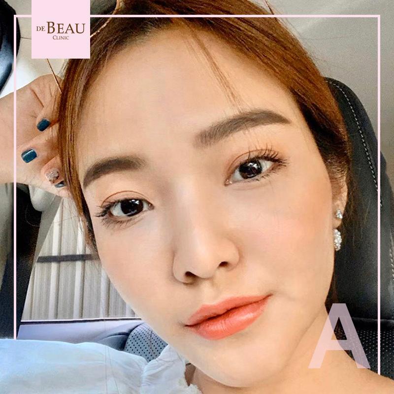 Review ฟิลเลอร์ใต้ตา คุณโบว์ BY DE BEAU CLINIC