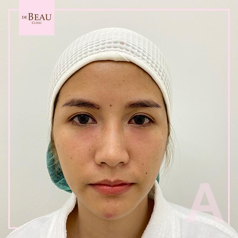 Review ฟิลเลอร์ใต้ตา คุณนุช BY DE BEAU CLINIC