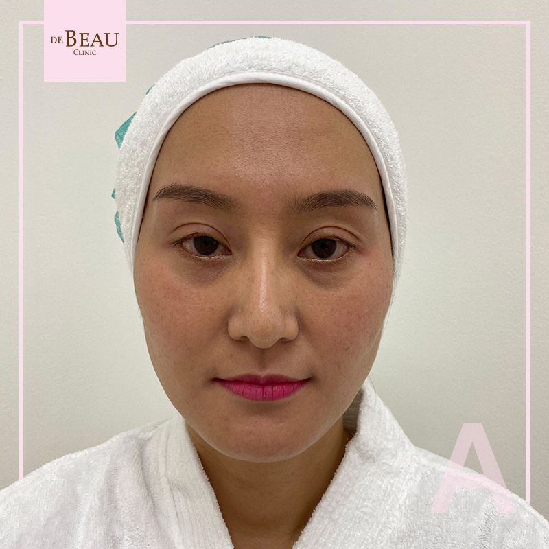 Review ฟิลเลอร์ใต้ตา คุณวรรณ BY DE BEAU CLINIC