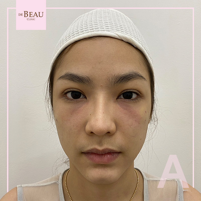 Review ฟิลเลอร์ใต้ตา คุณเจน BY DE BEAU CLINIC