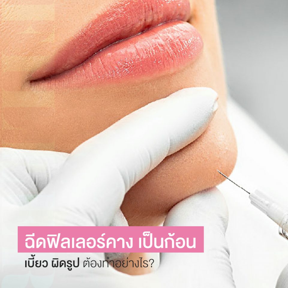 ฉีดฟิลเลอร์คาง เป็นก้อน เบี้ยว ผิดรูป ควรทำอย่างไร