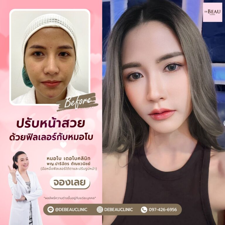 ฉีดฟิลเลอร์แก้ปัญหาใต้ตา