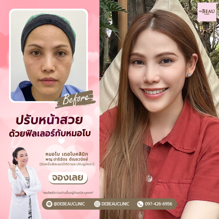 ฉีดฟิลเลอร์แก้ปัญหาใต้ตา