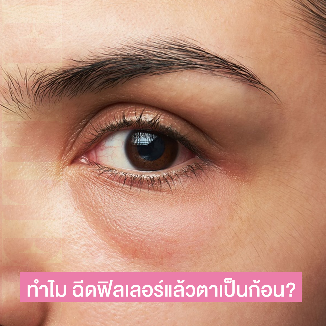 ฉีดฟิลเลอร์แล้วตาเป็นก้อน เป็นลำ สาเหตุเกิดจากอะไร?