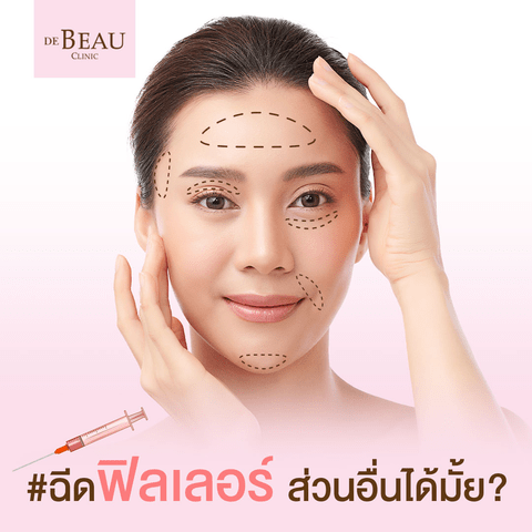 ฟิลเลอร์ ฉีดส่วนอื่นได้มั้ย? นอกจากหน้า ฉีดหน้าอก หรือตามตัวได้มั้ย
