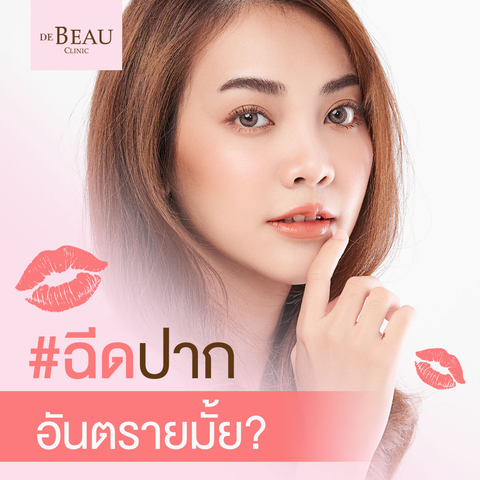 ฉีดปากอันตรายมั้ย? เตรียมตัวยังไง ใครควรฉีด”ฟิลเลอร์ปาก”