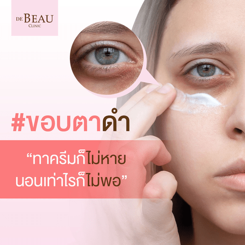 ขอบตาดำ ทาครีมก็ไม่หาย นอนเท่าไรก็ไม่พอ ต้องทำอย่างไร?