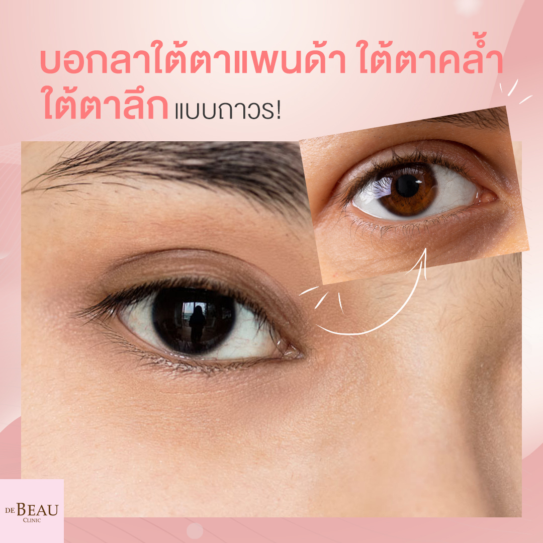 4 วิธีบอกลาใต้ตาแพนด้า ใต้ตาคล้ำ ใต้ตาลึก แบบถาวร!
