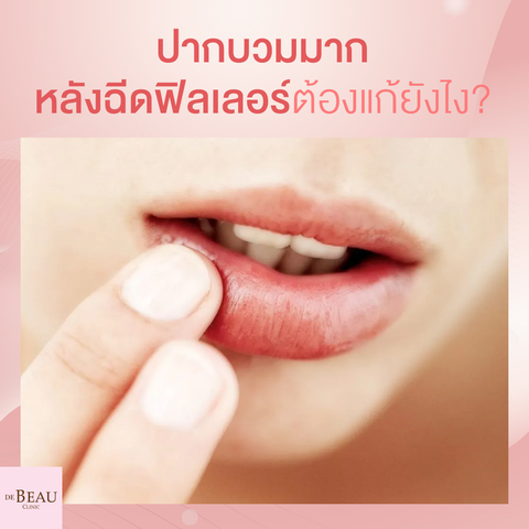 ฉีดปาก บวมมาก หลังฉีดฟิลเลอร์ ต้องแก้ยังไง?