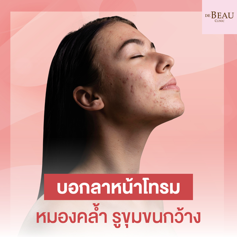 บอกลาหน้าโทรม หมองคล้ำ รูขุมขนกว้าง แบบได้ผล 100%