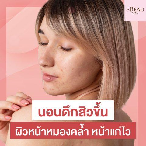 นอนดึกสิวขึ้น ผิวหน้าหมองคล้ำ หน้าแก่ไว
