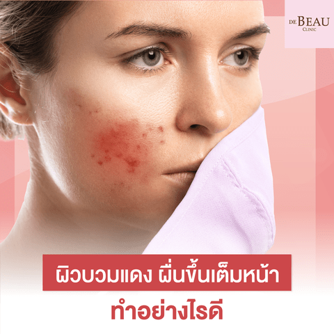 วิธีดูแลผิวบวมแดง ผื่นขึ้นเต็มหน้า ทำอย่างไรดีให้หายไว ๆ