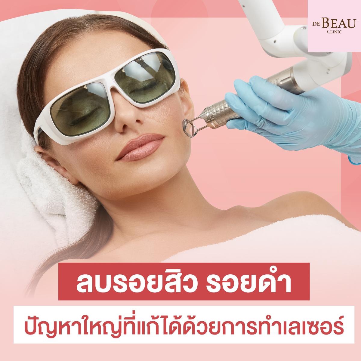 ลบรอยสิว รอยดํา ปัญหาใหญ่ที่แก้ได้ด้วยการทำเลเซอร์
