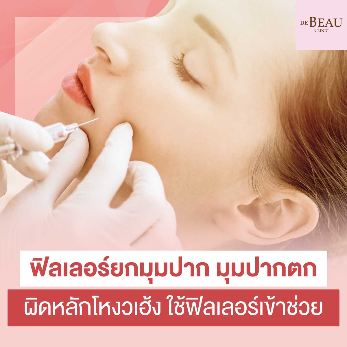ฟิลเลอร์ยกมุมปาก มุมปากตก ผิดหลักโหงวเฮ้ง ใช้ฟิลเลอร์เข้าช่วย