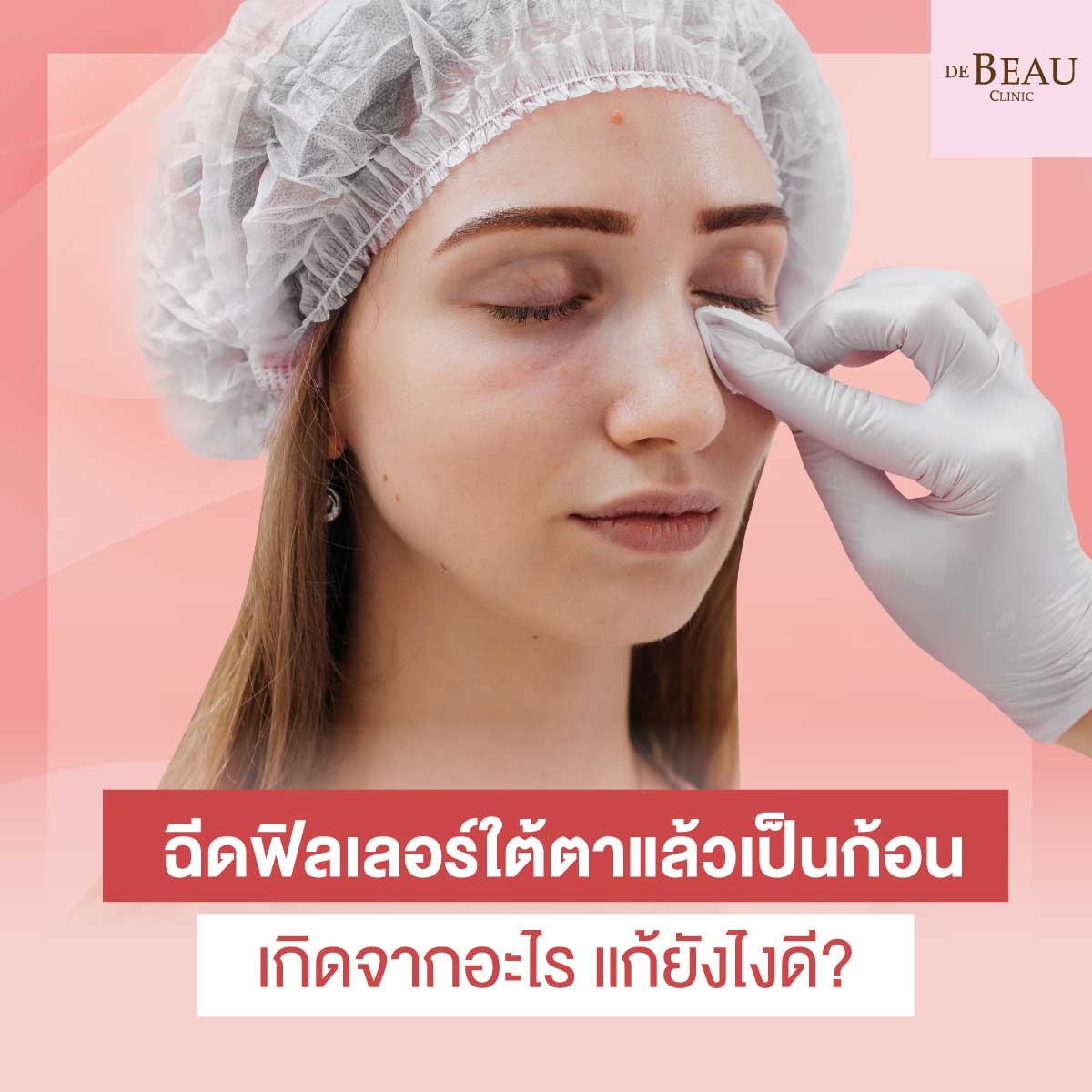 ฉีดฟิลเลอร์ใต้ตาแล้วเป็นก้อน เกิดจากอะไร แก้ยังไงดี?