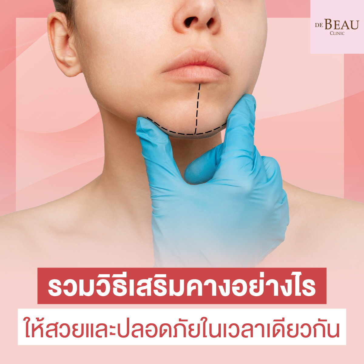 เสริมคาง