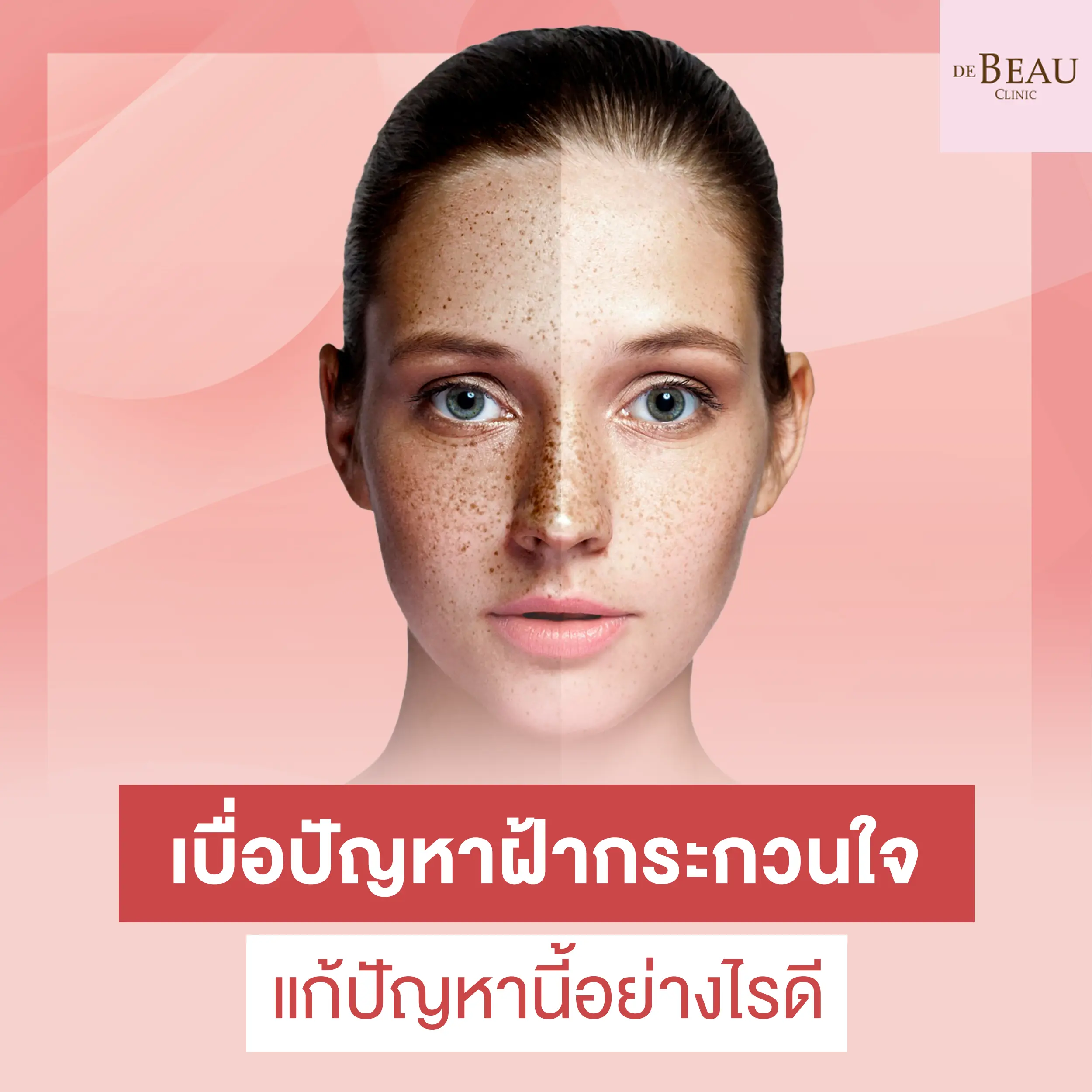 เบื่อปัญหาฝ้ากระกวนใจ แก้ปัญหานี้อย่างไรดี