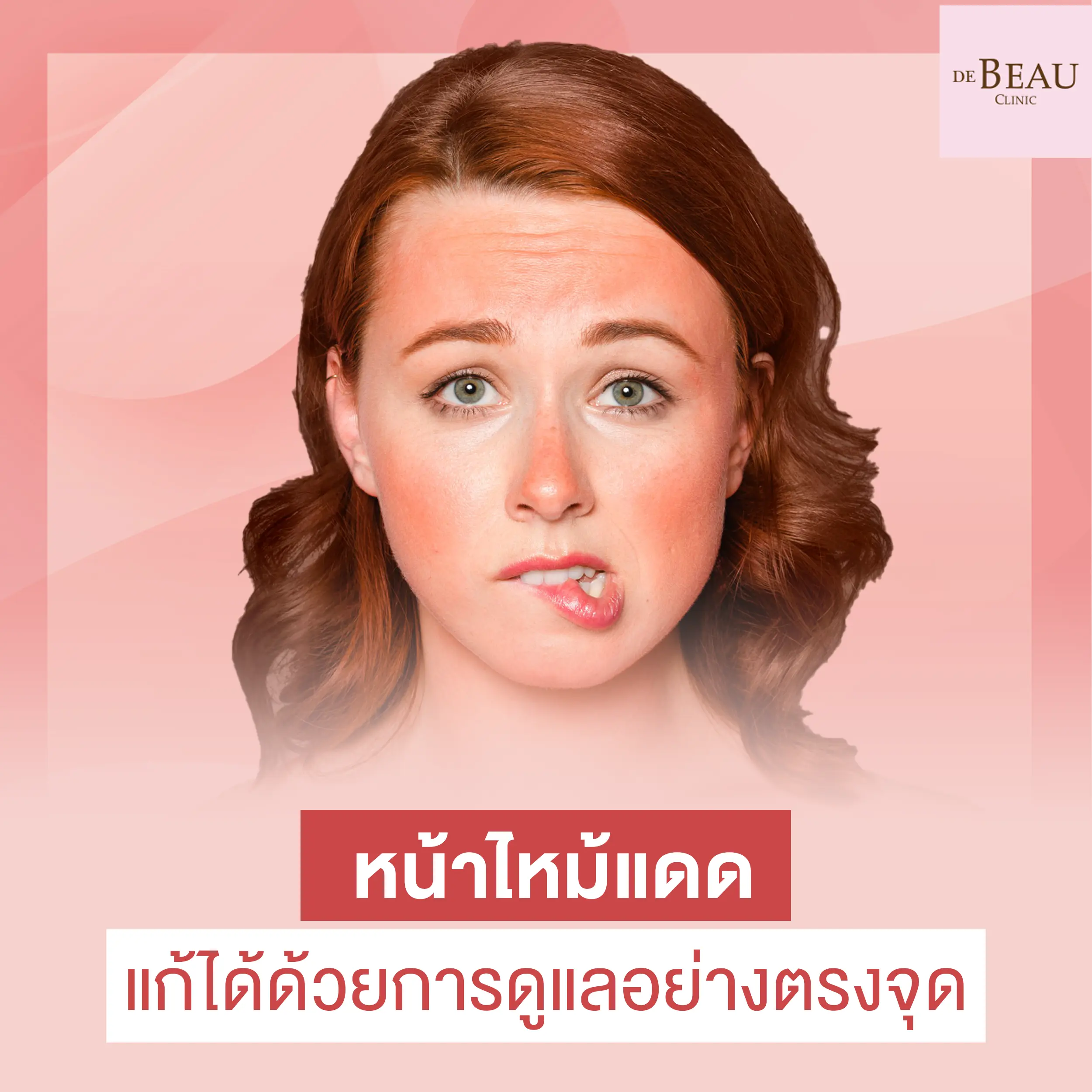 หน้าไหม้แดด แก้ได้ด้วยการดูแลอย่างตรงจุด