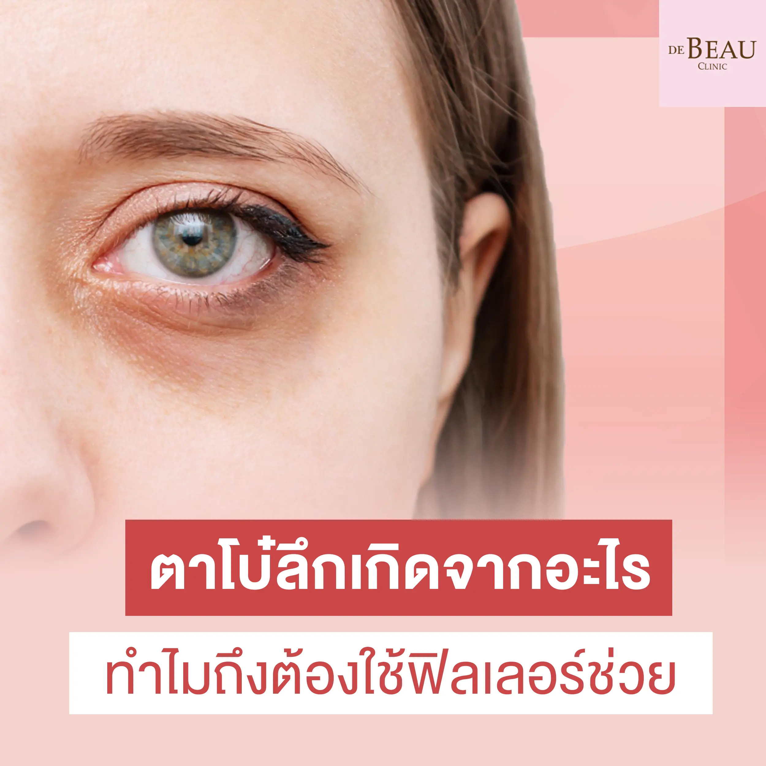 ตาโบ๋ลึกเกิดจากอะไร ทำไมถึงต้องใช้ฟิลเลอร์ช่วย