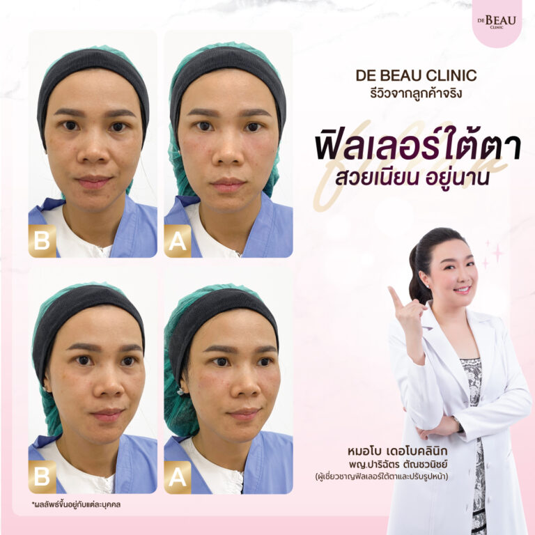 ฉีดฟิลเลอร์แก้ปัญหาใต้ตา