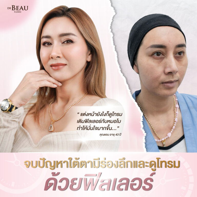ฉีดฟิลเลอร์แก้ปัญหาใต้ตา