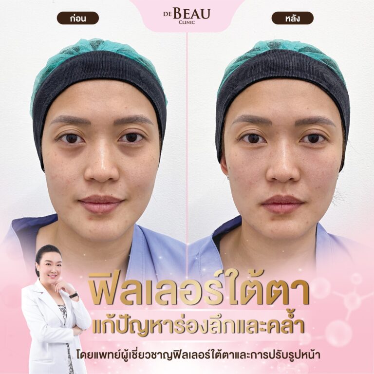 ฉีดฟิลเลอร์แก้ปัญหาใต้ตา