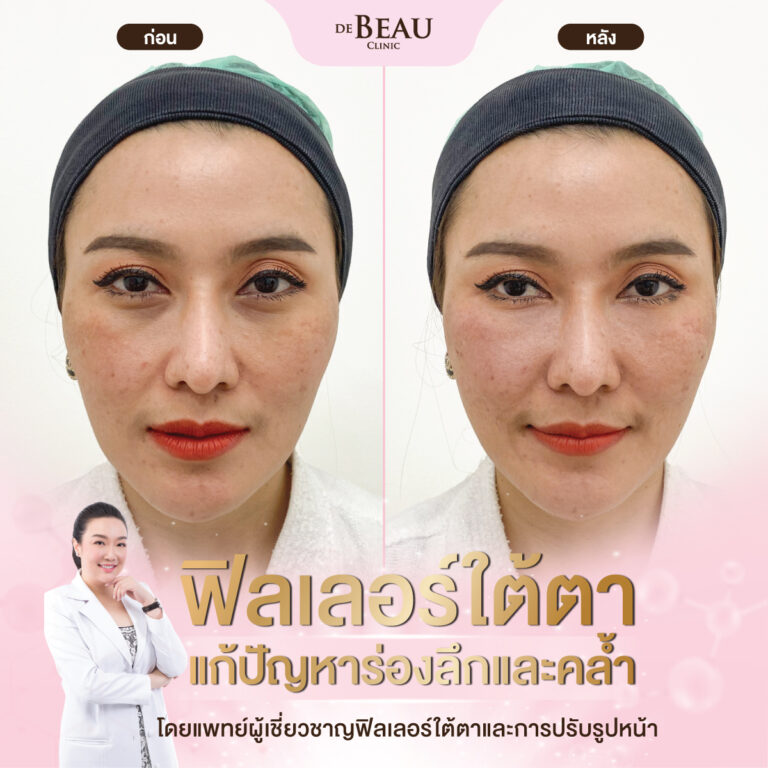 ฉีดฟิลเลอร์แก้ปัญหาใต้ตา