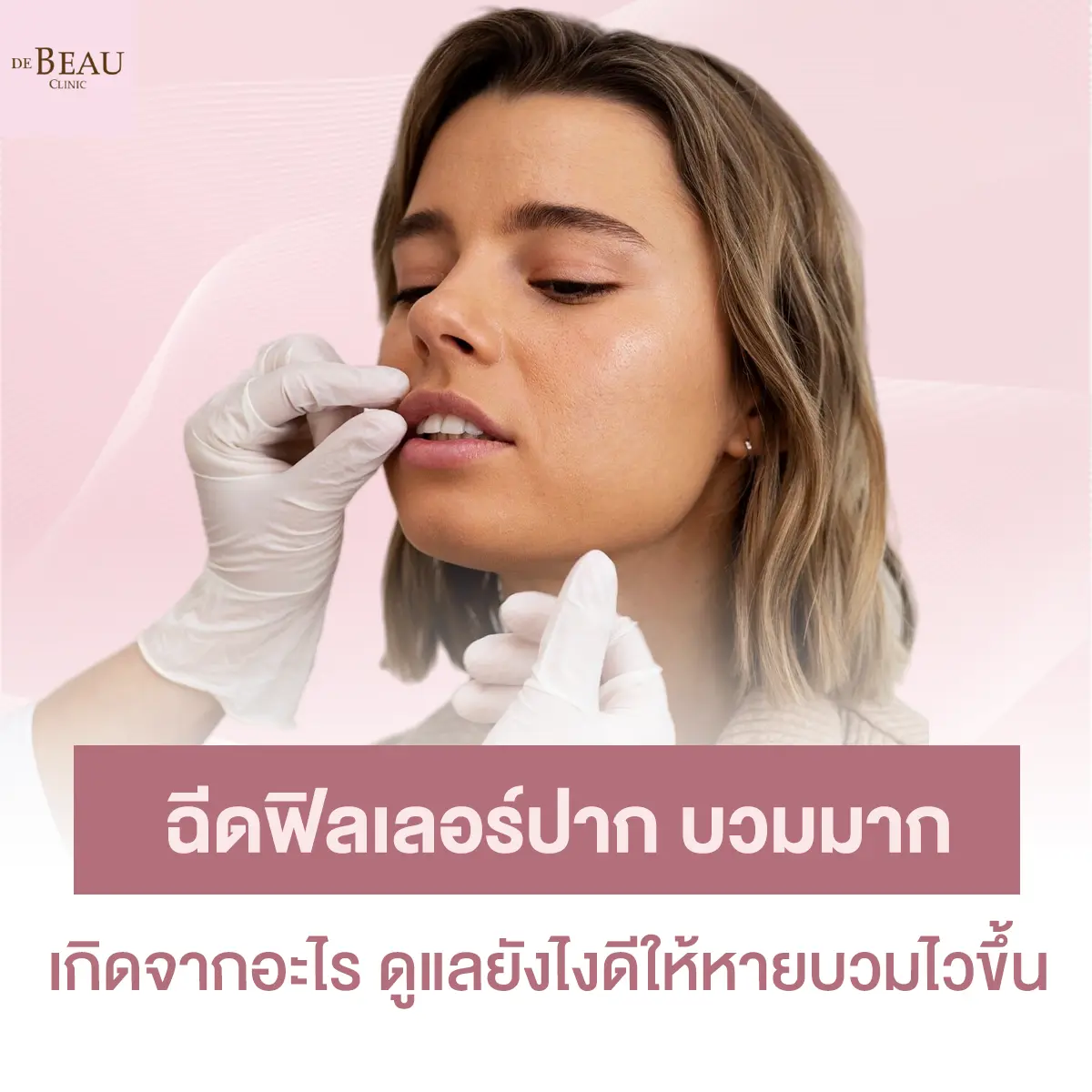 ฉีดฟิลเลอร์ปาก บวมมาก เกิดจากอะไร ดูแลยังไงดีให้หายบวมไวขึ้น