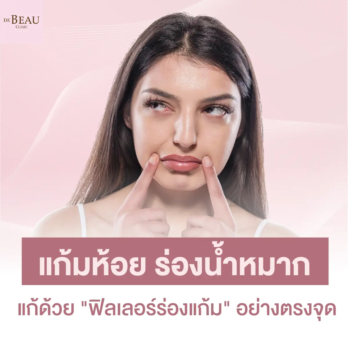 แก้มห้อย ร่องน้ำหมาก แก้ด้วย “ฟิลเลอร์ร่องแก้ม” อย่างตรงจุด