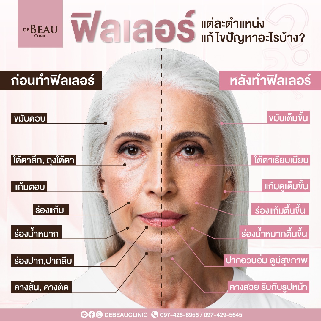 โปรแกรมฟิลเลอร์